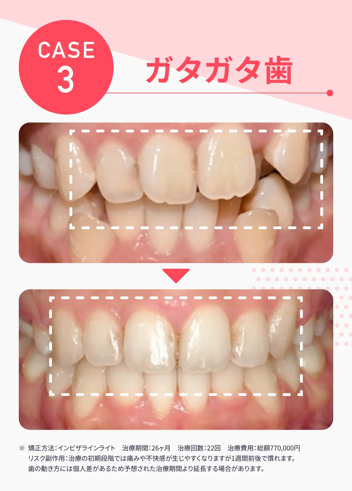 CASE3 ガタガタ歯