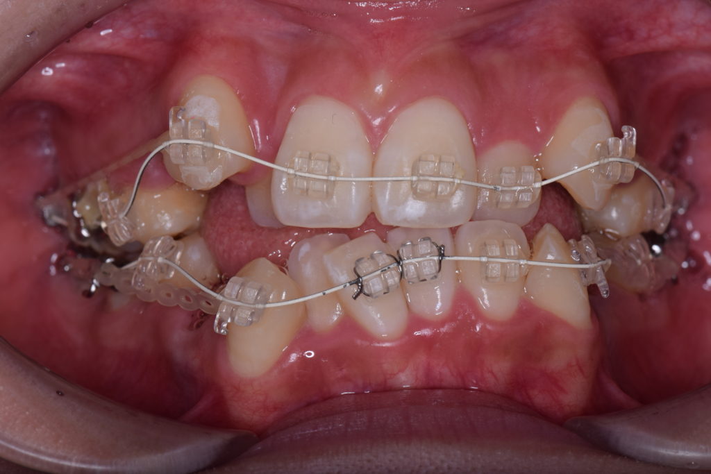 成人の歯列矯正期間は10歳年齢差があると２倍かかる