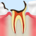 虫歯治療の平均通院回数と通院時の治療内容について。