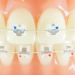 歯が黄ばみやすい矯正治療中でもきれいに保つには？
